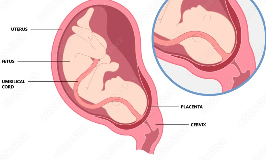 What Causes Placenta Percreta?