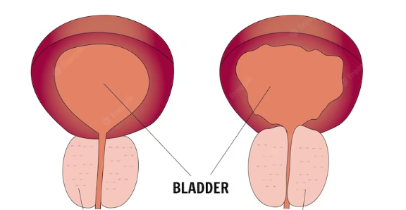 What causes Placenta Increta?